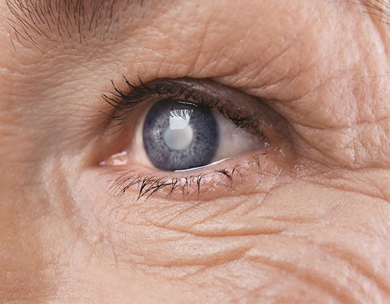 Choosing the Right Cataract Treatment