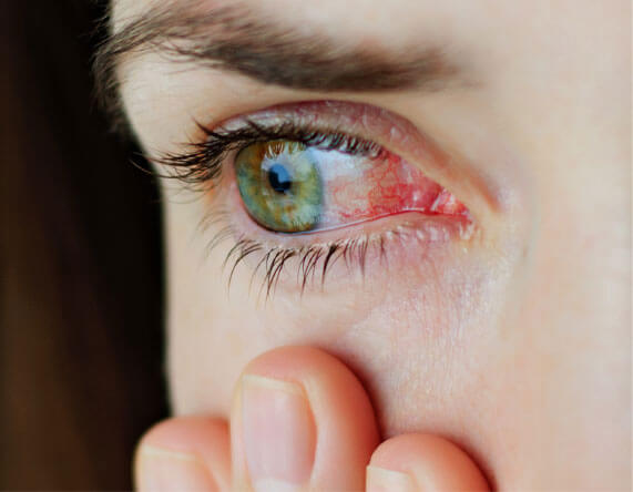 Is Your Eye Pink? It May (or May Not) be Pink Eye