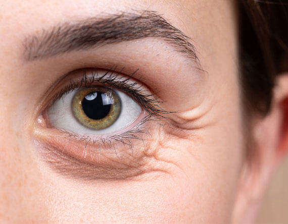 Blepharoplasty: A Medical and Cosmetic Option