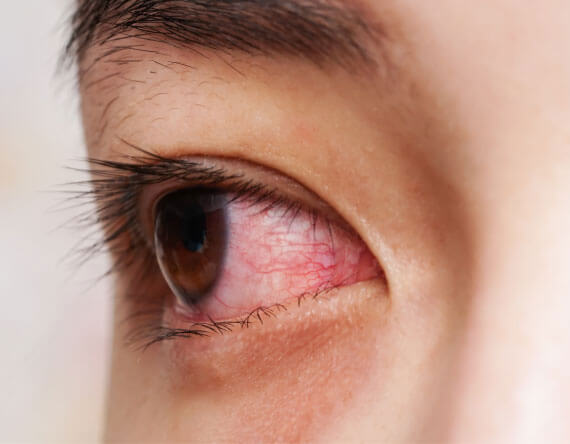 Episcleritis and Scleritis