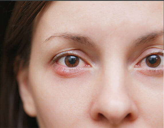 Styes and Chalazions