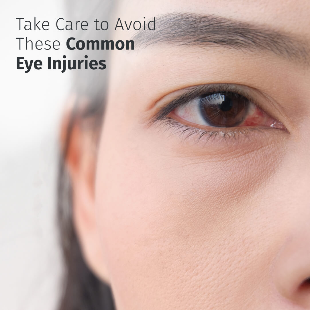 Five Common Eye Injuries and How to Prevent Them