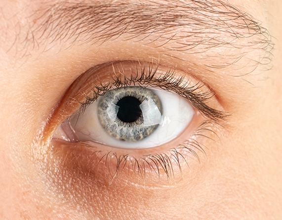 Keratoconus: What It Is and How to Treat It