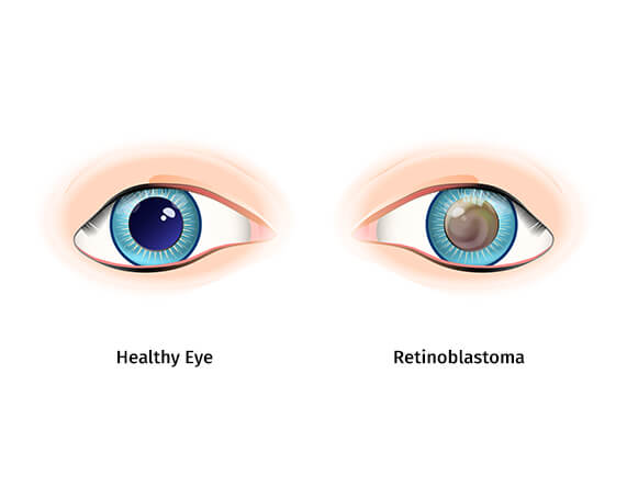 What Is Retinoblastoma?