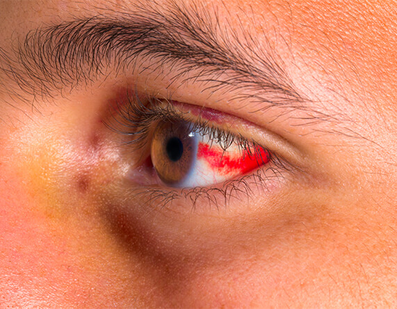 What Is Hyphema?