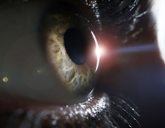 What Is Photokeratitis?
